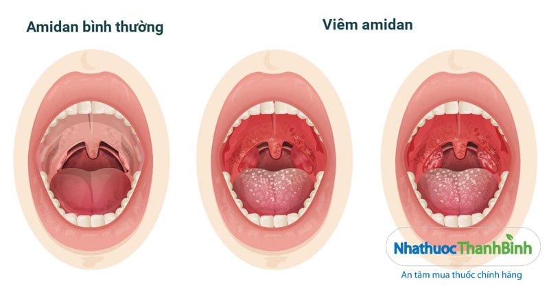 Viêm amidan là bệnh thường gặp ở hệ hô hấp của cả người lớn và trẻ em