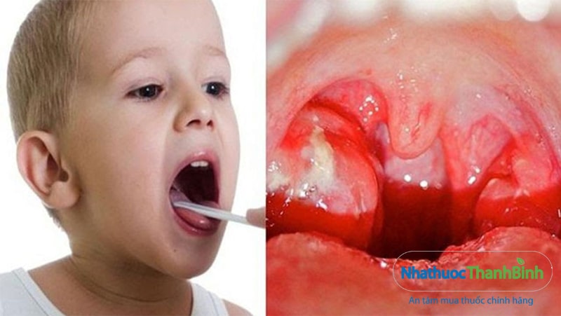 Phẫu thuật cắt amidan là một trong các phương pháp điều trị hiệu quả viêm amidan