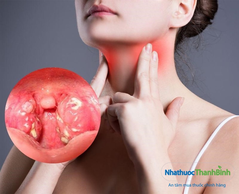 Sưng đau họng và khó nuốt là một trong các triệu chứng của bệnh viêm amidan