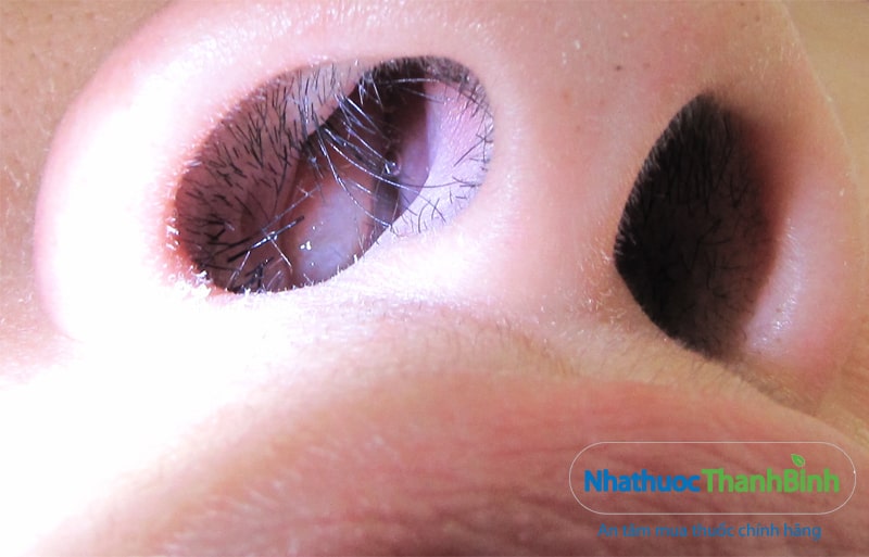 Hình ảnh Polyp mũi gây nghẹt mũi cản trở hô hấp