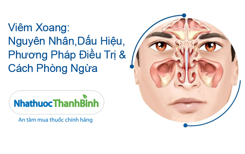Viêm xoang là tình trạng niêm mạc xoang cạnh mũi bị viêm gây tích tụ chất nhầy bên trong