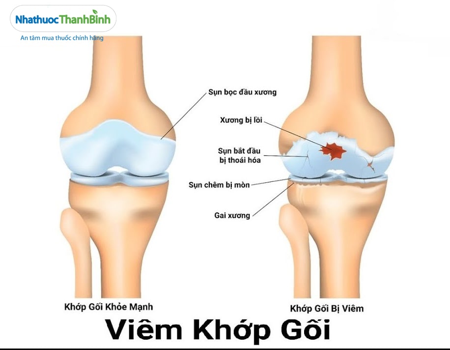 Hình ảnh viêm khớp gối