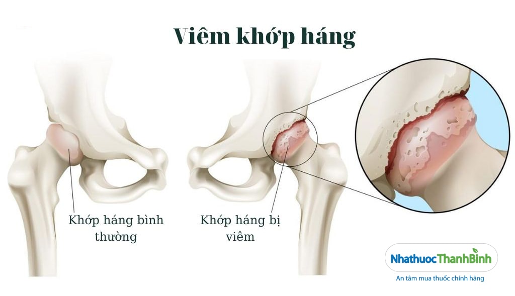 Hình ảnh minh họa bệnh viêm khớp háng