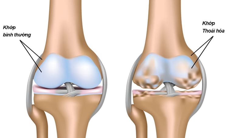 Thoái hóa khớp ảnh hưởng rất nhiều tới cuộc sống sinh hoạt
