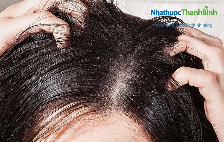 Hình ảnh minh họa bệnh nấm da đầu