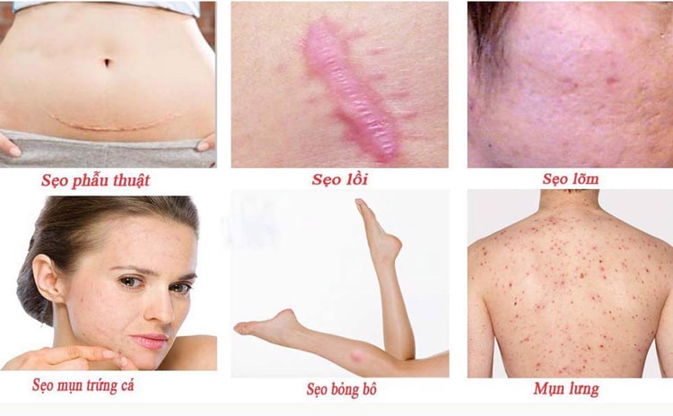 Kem trị sẹo Jeju Gel giúp trị sẹo giảm thâm an toàn cho phụ nữ mang thai và cho con bú