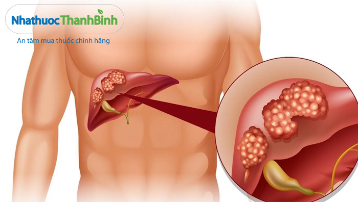 Hình ảnh minh họa bệnh viêm gan