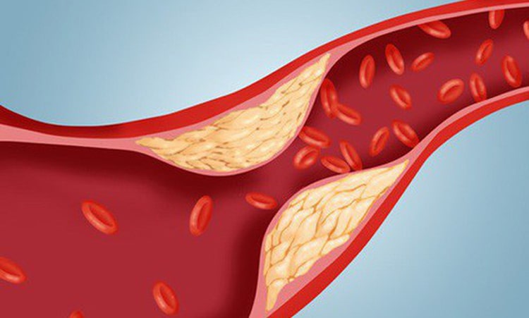 Viên giảm cân Slim Body giúp hỗ trợ điều trị mỡ máu