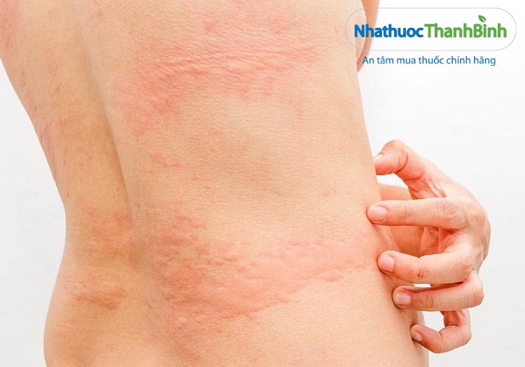 Hình ảnh minh họa bệnh mày đay