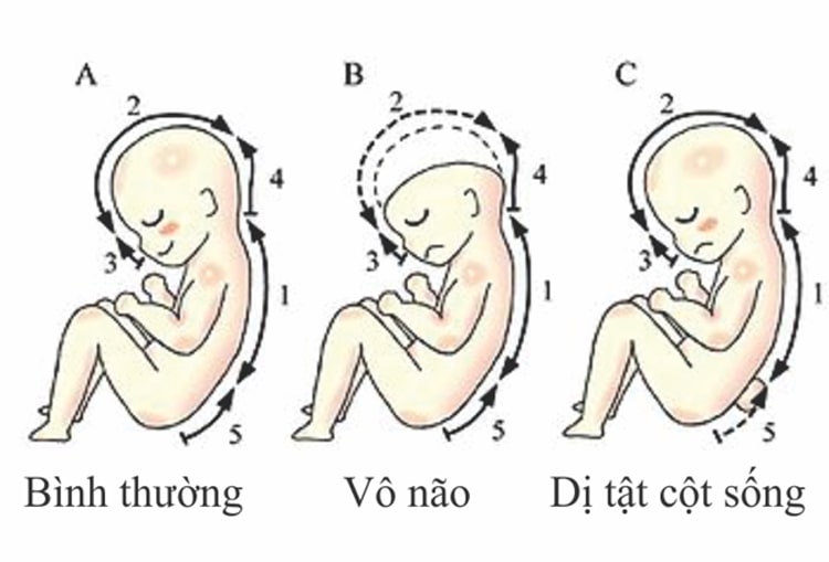 Thiếu axit folic tăng nguy cơ dị tật ống thần kinh ở thai nhi