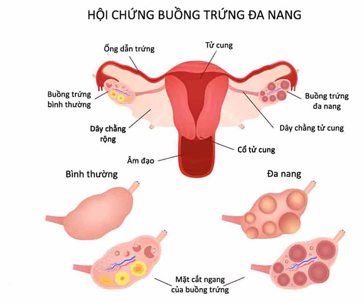 Bệnh buồng trứng đa nang