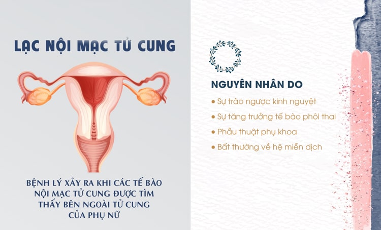 Lạc nội mạc tử cung có thể gây vô sinh ở nữ giới