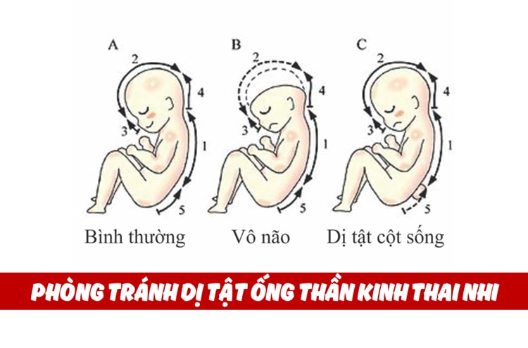 Femifortil giúp ngăn ngừa dị tật ống thần kinh thai nhi