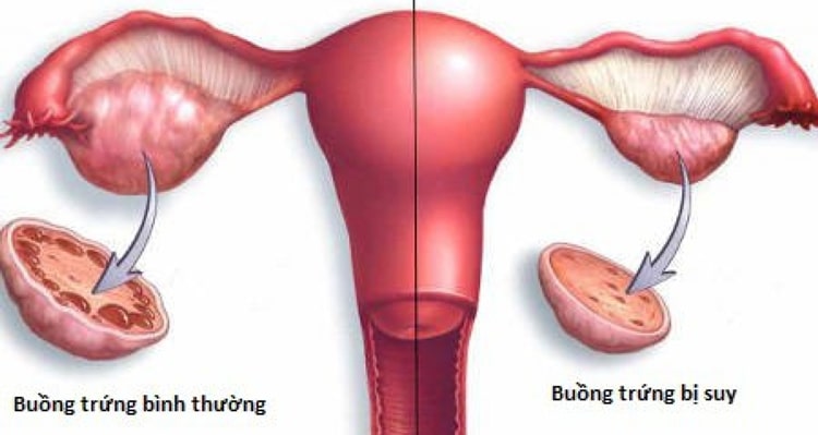 Uống Femifortil còn giúp giảm thiểu nguy cơ suy buồng trứng sớm