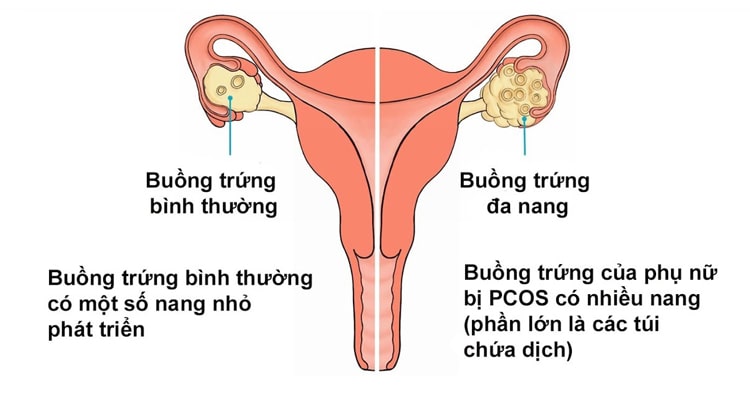 Gametix F giúp hỗ trợ điều trị buồng trứng đa nang hiệu quả