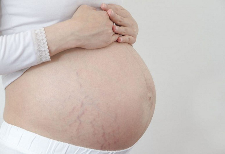 Sản phẩm an toàn và hiệu quả chống rạn da cho phụ nữ mang thai