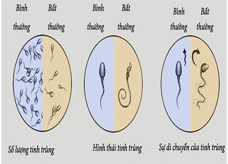 Tinh trùng yếu, dị dạng là một trong những nguyên nhân chính gây vô sinh hiếm muộn nam