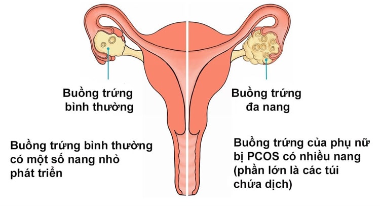 Hội chứng buồng trứng đa nang PCOS là một trong các nguyên nhân chính gây vô sinh hiếm muộn nữ