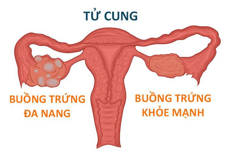 Sản phẩm rất tốt trong hỗ trợ điều trị hội chứng buồng trứng đa nang (PCOS)