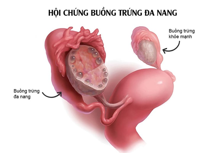 Buồng trứng đa nang đang là nguyên nhân phổ biến gây vô sinh hiếm muộn ở nữ giới