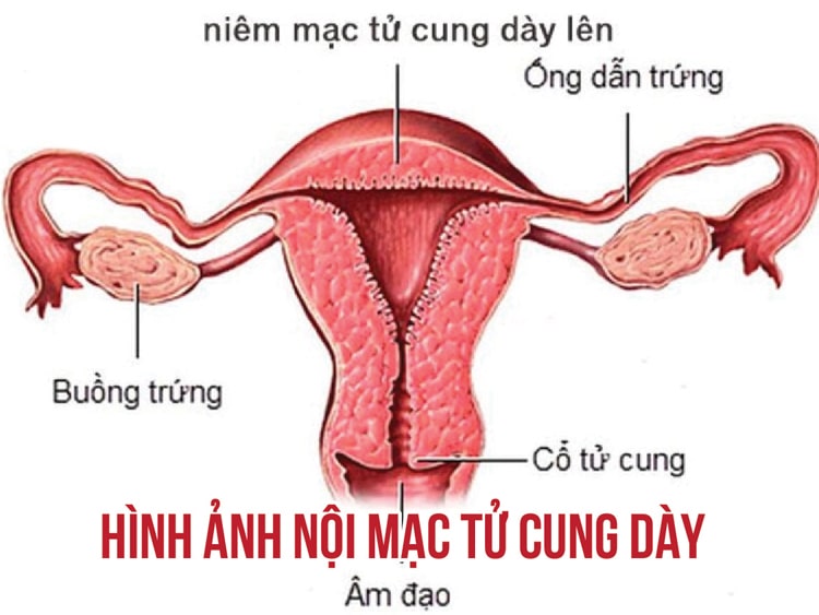 Progynova 2mg giúp làm dày niêm mạc tử cung
