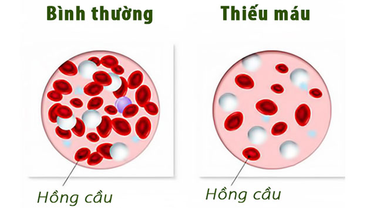 Bệnh thiếu máu thiếu sắt rất nguy hiểm