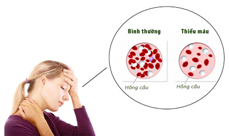 Thiếu máu do thiếu sắt- tác nhân gây mệt mỏi cơ thể