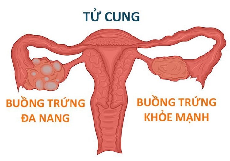 TPCN Schonheits Kapseln giúp hỗ trợ điều trị buồng trứng đa nang