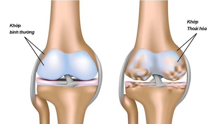 Tình trạng thoái hóa khớp ở người cao tuổi