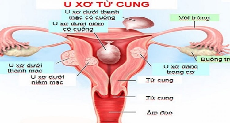 Crisharvin Gold hỗ trợ ức chế sự phát triển của u xơ tử cung