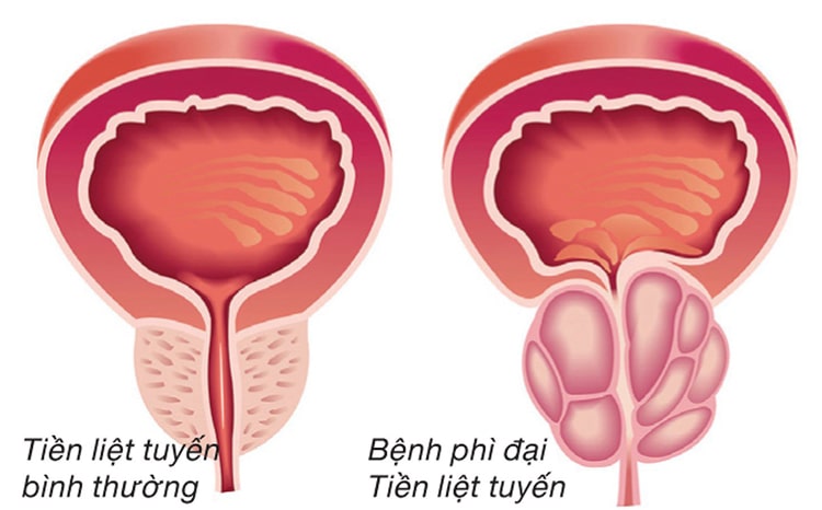 Sản phẩm giúp hỗ trợ giảm các triệu chứng của bệnh phì đại tiền liệt tuyến