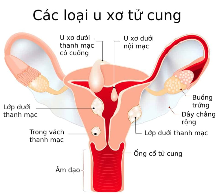 Tiêu ngai bình giúp thanh nhiệt tán ư hỗ trợ sự tiến triển của u xơ tử cung, u nang buồng trứng
