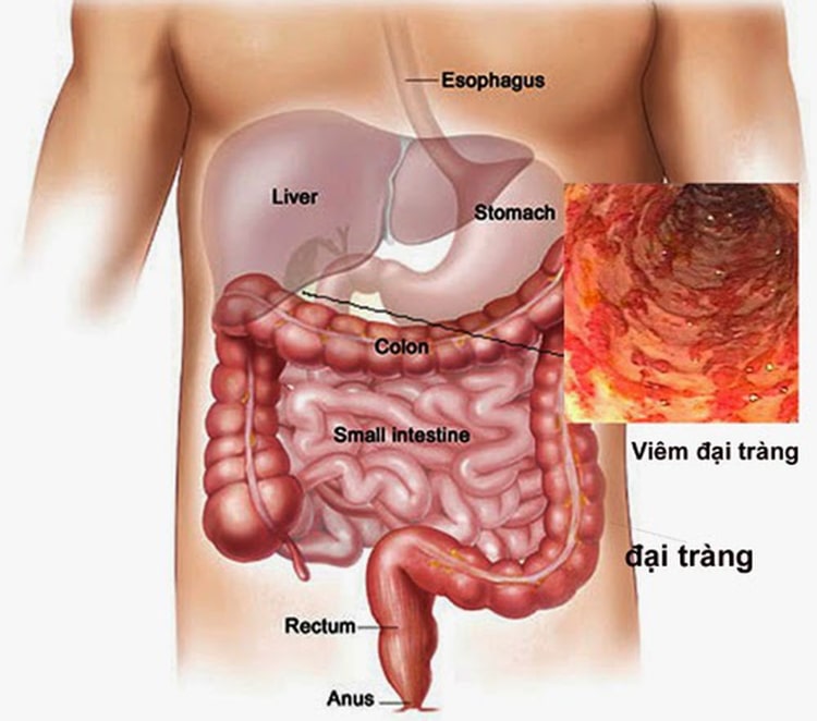 Sản phẩm còn giúp giảm các triệu chứng của bệnh viêm đại tràng, rối loạn tiêu hóa