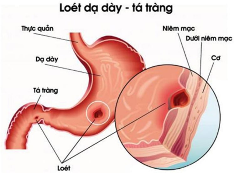 Bệnh viêm loét dạ dày tá tràng