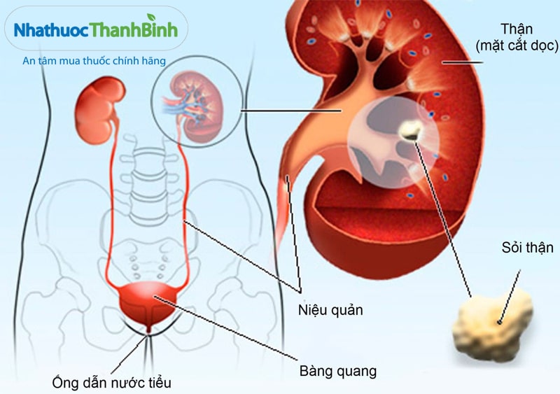 Hình ảnh sỏi thận
