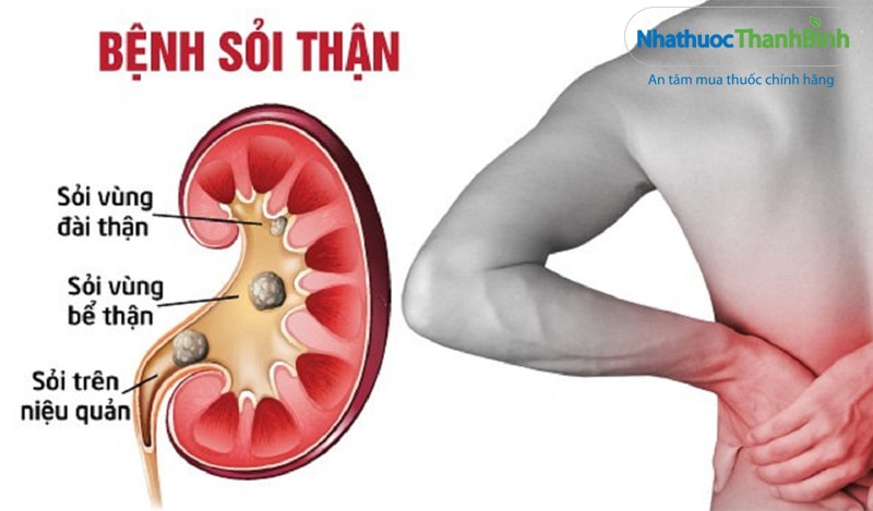 Hình ảnh minh họa triệu chứng của bệnh sỏi thận