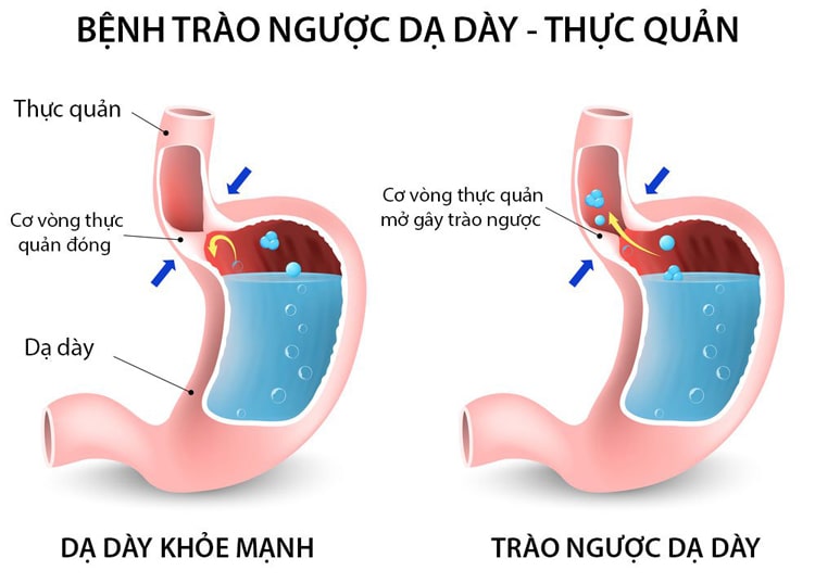 Sản phẩm giúp hỗ trợ giảm trào ngược dạ dày - thực quản hiệu quả