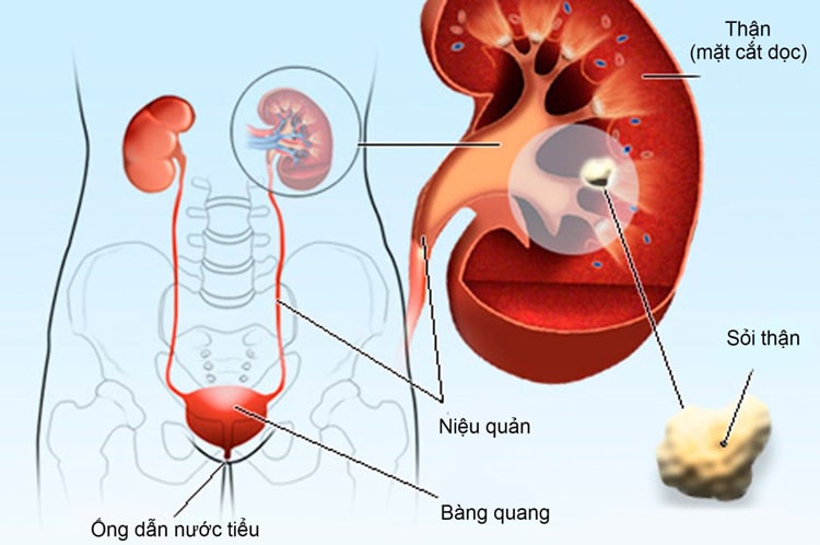 Super Power UriClean giúp ngăn ngừa quá trình hình thành sỏi thận và ngăn ngừa sỏi tái phát