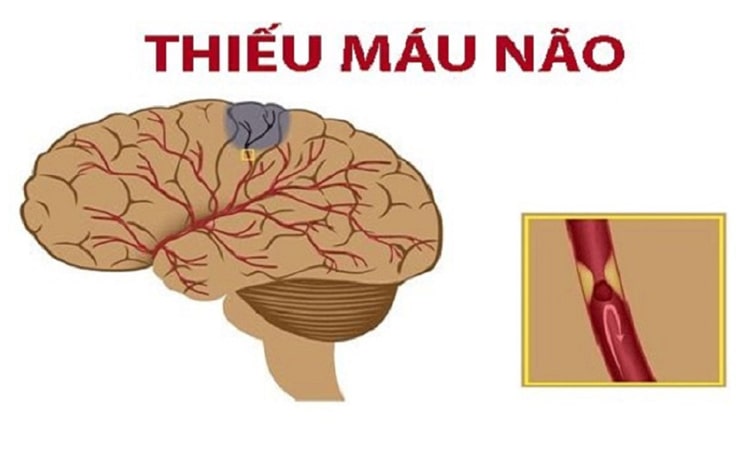 Thiếu máu lên não gây tình trạng nhức đầu, chóng mặt, mất thăng bằng