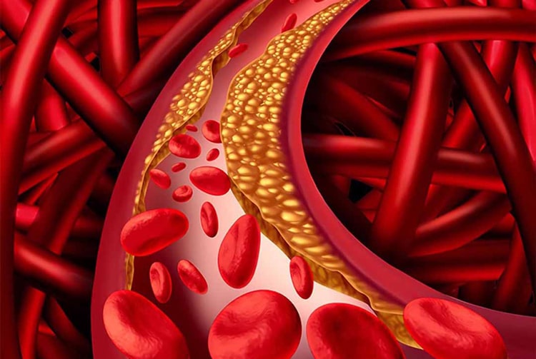 Mỡ máu cao là tác nhân gây ra nhiều bệnh tim mạch nguy hiểm