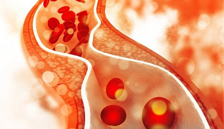 Cholesterol trong máu cao là nguyên nhân chính gây ra các bệnh tim mạch