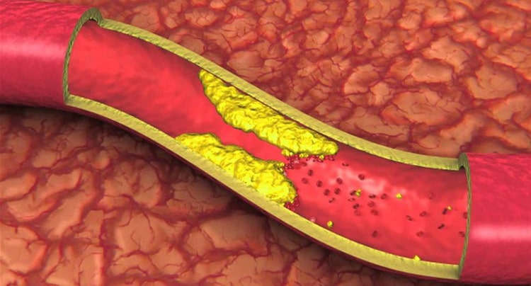 Thuốc Orasten giúp điều trị bệnh rối loạn chuyển hóa lipid máu
